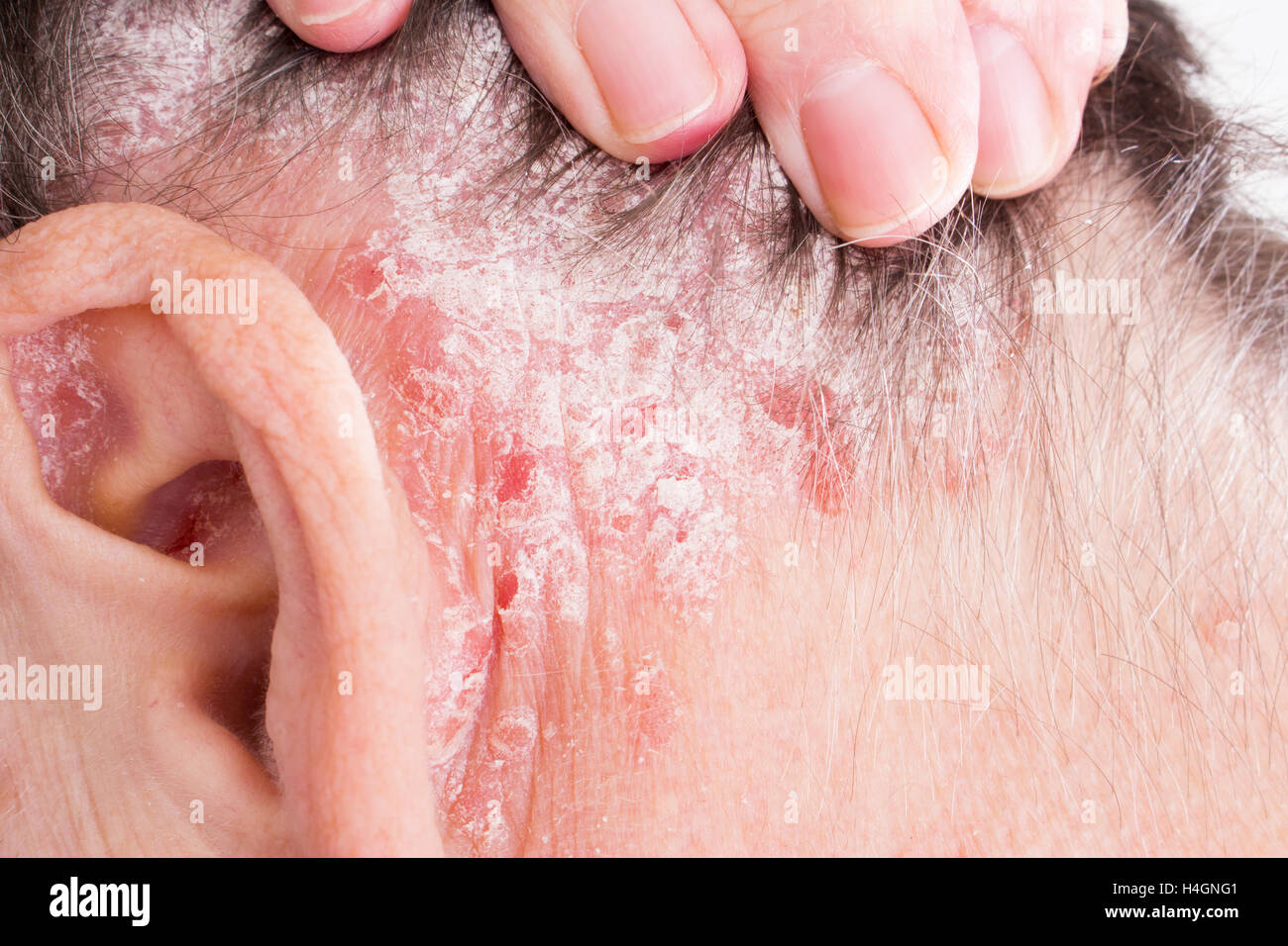 Psoriasis Vulgaris Psoriatic Skin Disease In Hair Skin Patches