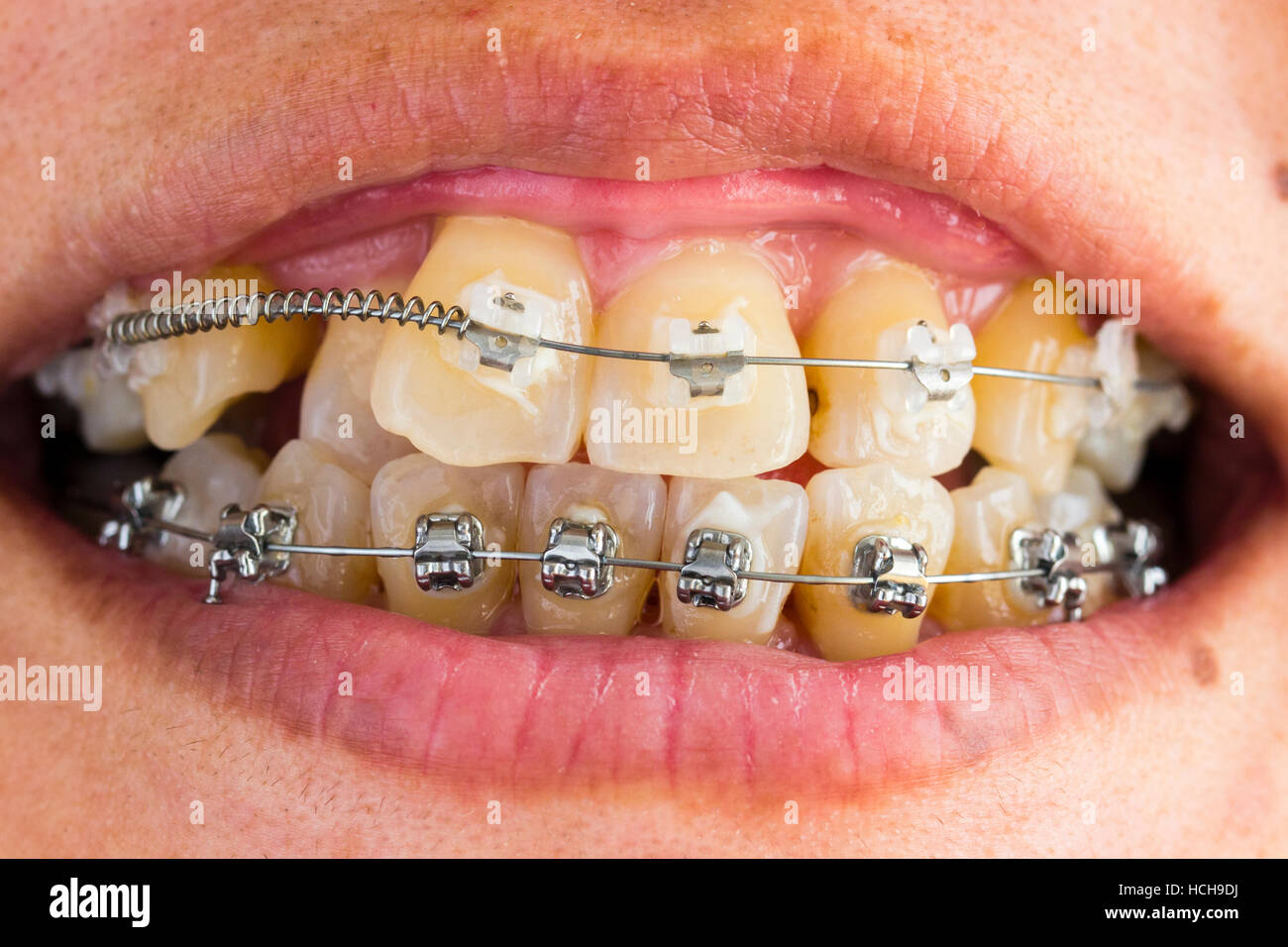 Teeth brace. Wire brace around bottom and upper teeth in order to Stock