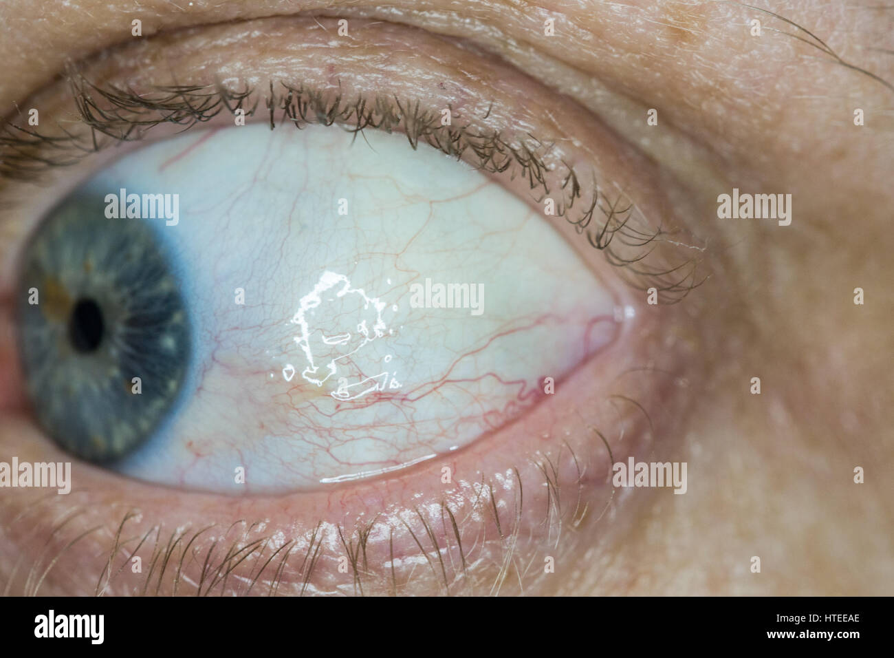 Sun burn damage to eye, known as Pinguecula causes a hardening lump