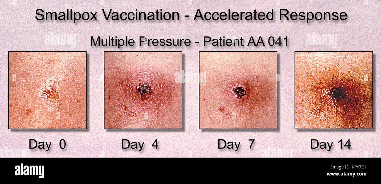 the victory of medicine over smallpox in the 18th century Medicine: 18th-19th century | kids work share to google classroom medical research and training improved in the 18th century but there were still no cures for diseases like smallpox, a disease that killed millions of people over thousands of years. the victory of medicine over smallpox in the 18th century Medicine: 18th-19th century | kids work share to google classroom medical research and training improved in the 18th century but there were still no cures for diseases like smallpox, a disease that killed millions of people over thousands of years.