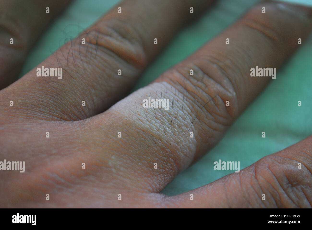 Skin That Is Burned By The Sun Stock Photo Alamy