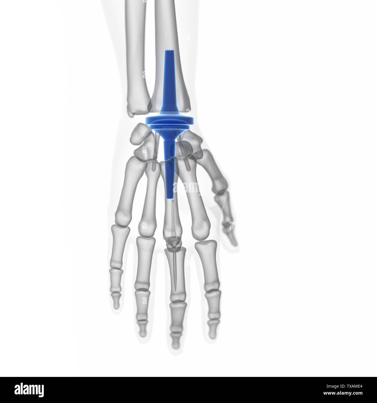 D Rendered Medically Accurate Illustration Of A Wrist Replacement