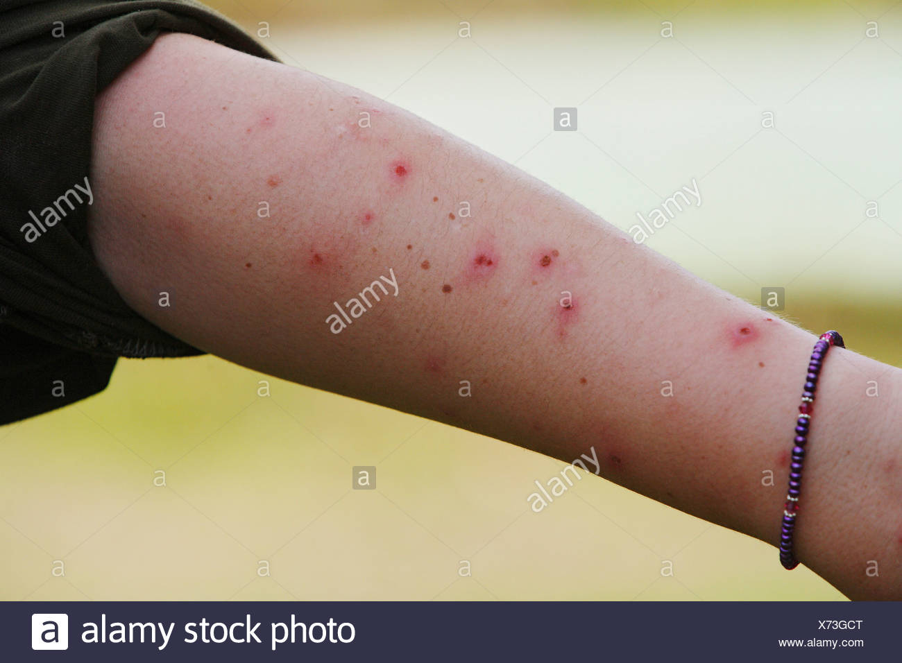 arm-covered-in-mosquito-bites-samboja-east-kalimantan-kalimantan-timur-borneo-indonesia-X73GCT.jpg