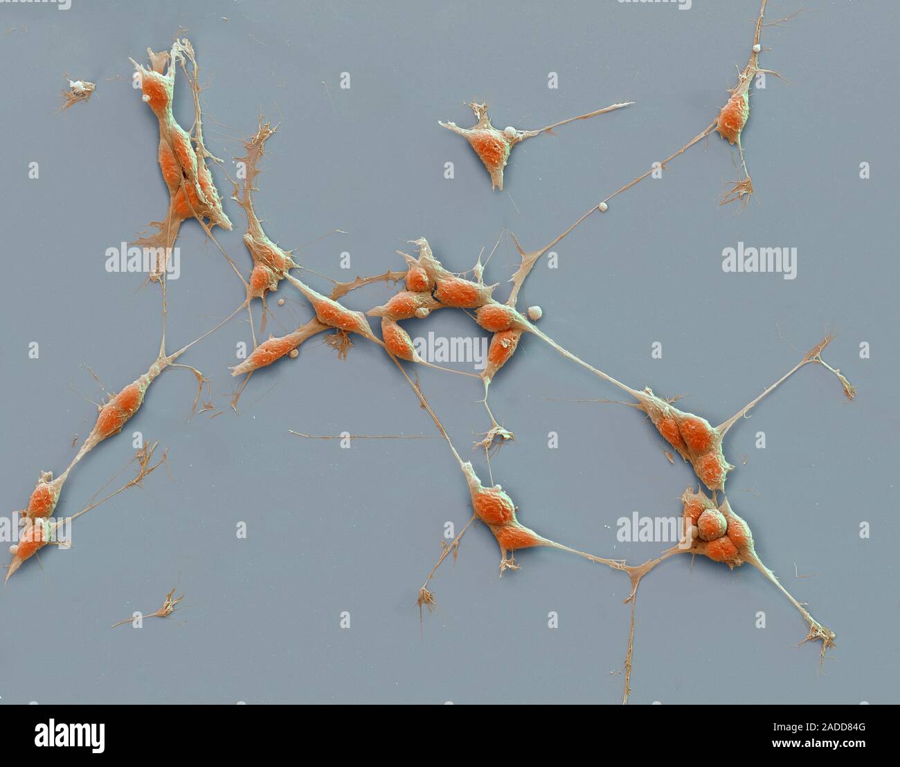 Neuroblastom Krebszellen Farbig Scanning Electron Micrograph Sem