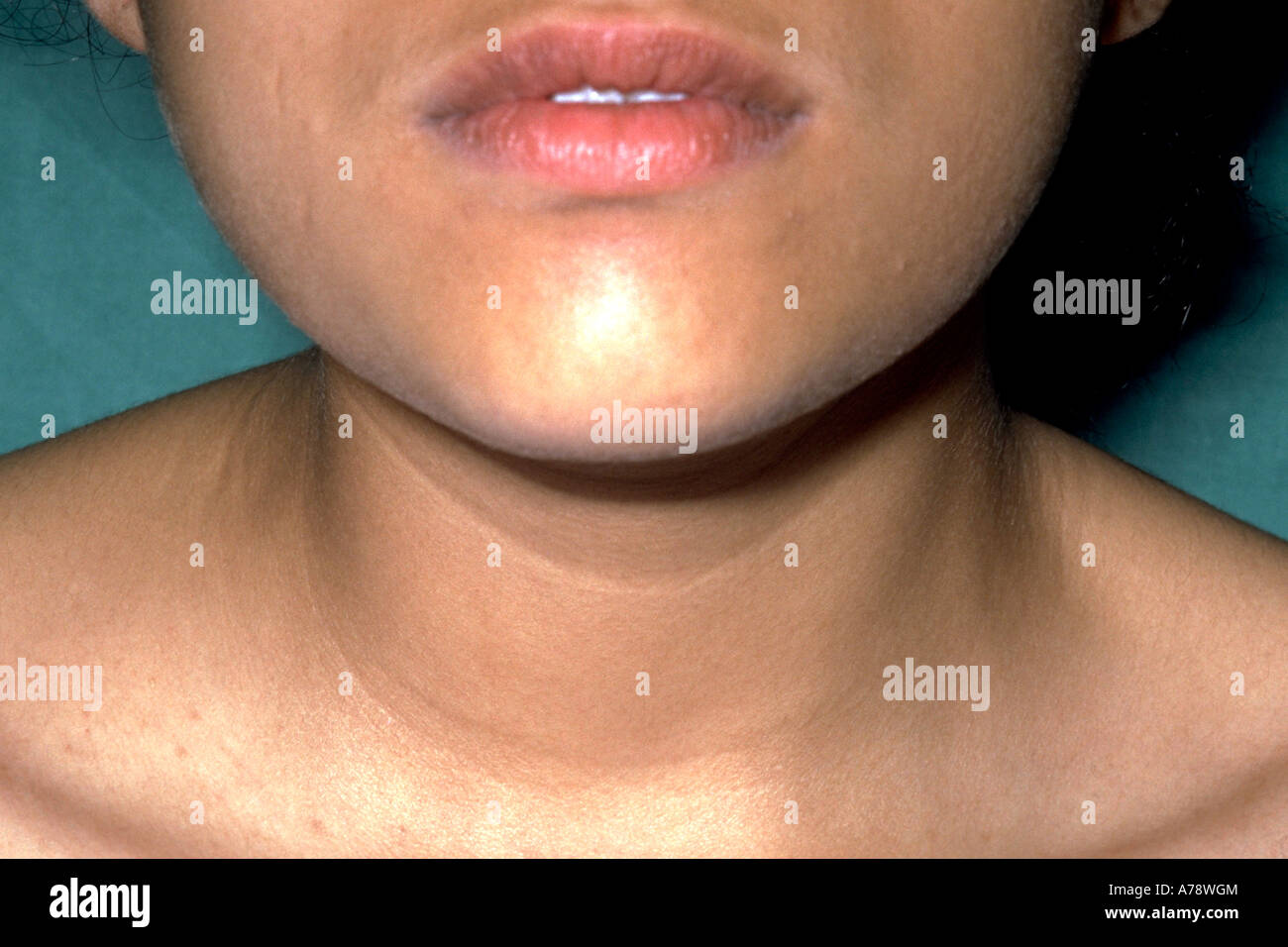Pus Abscess Stockfotos &amp; Pus Abscess Bilder Alamy