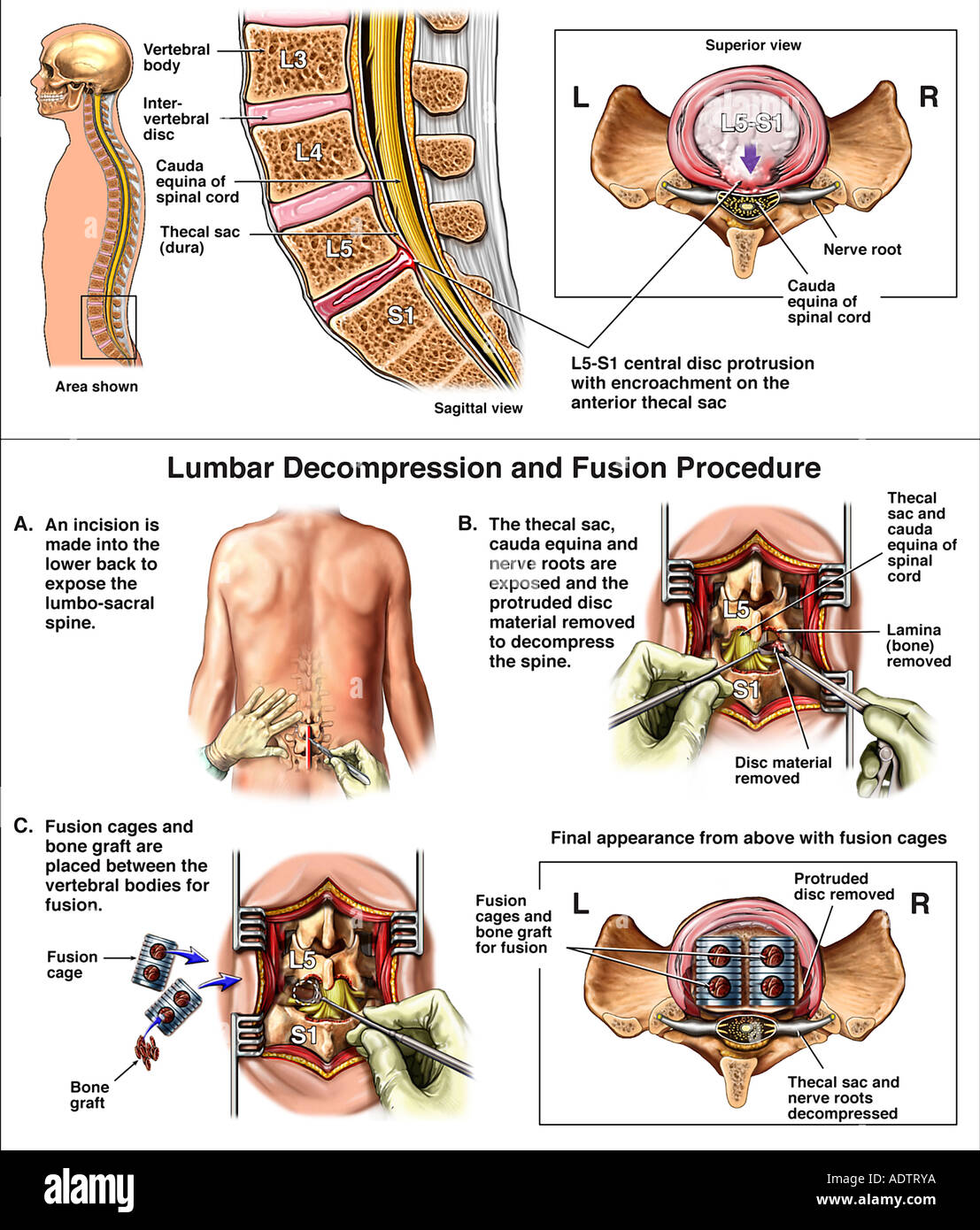 Lendenwirbelsäule Verletzungen Bandscheibenvorfall L5S1 mit hinteren SpondylodeseOperation