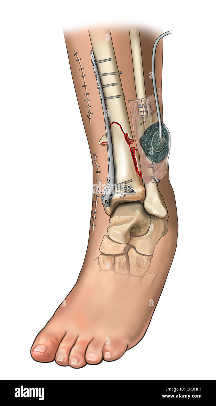 Tibial Fibulare Frakturfixation Fotos Und Bildmaterial In Hoher