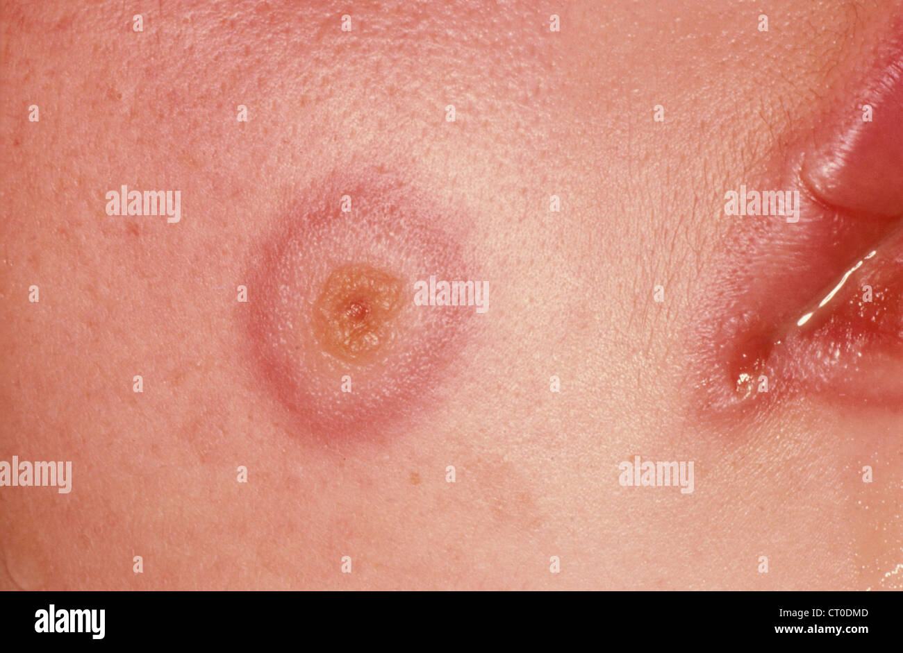 Erythema Stockfotos &amp; Erythema Bilder Alamy