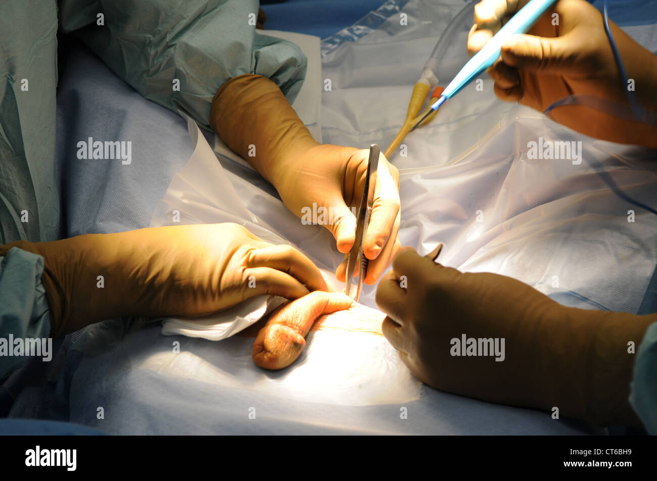 Male Genital Surgery Research Paper