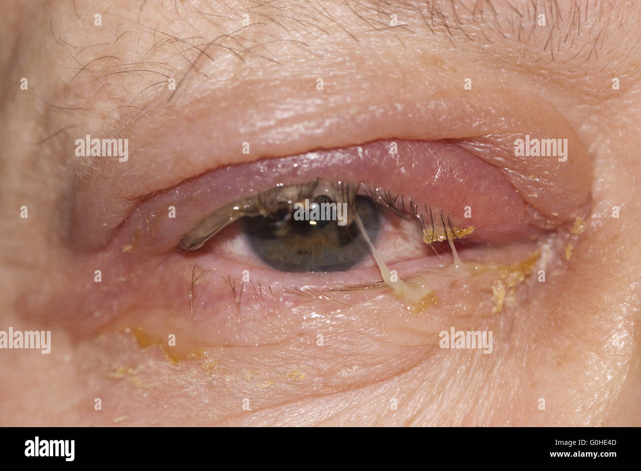 Stye Infection Stockfotos &amp; Stye Infection Bilder Alamy