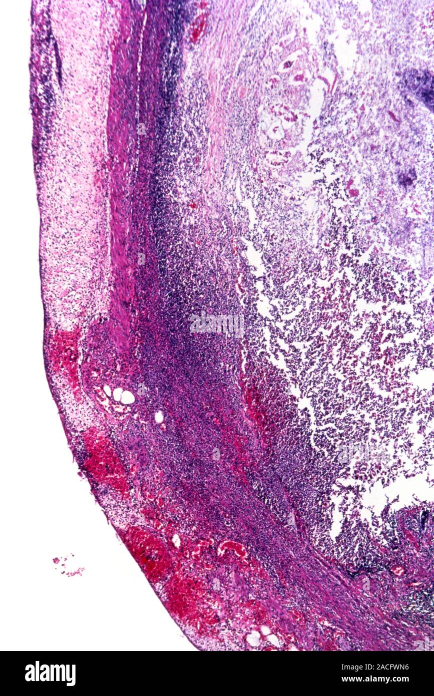 Apendicitis Gangrenoso Micrograf A De Luz A Trav S De Una Secci N De