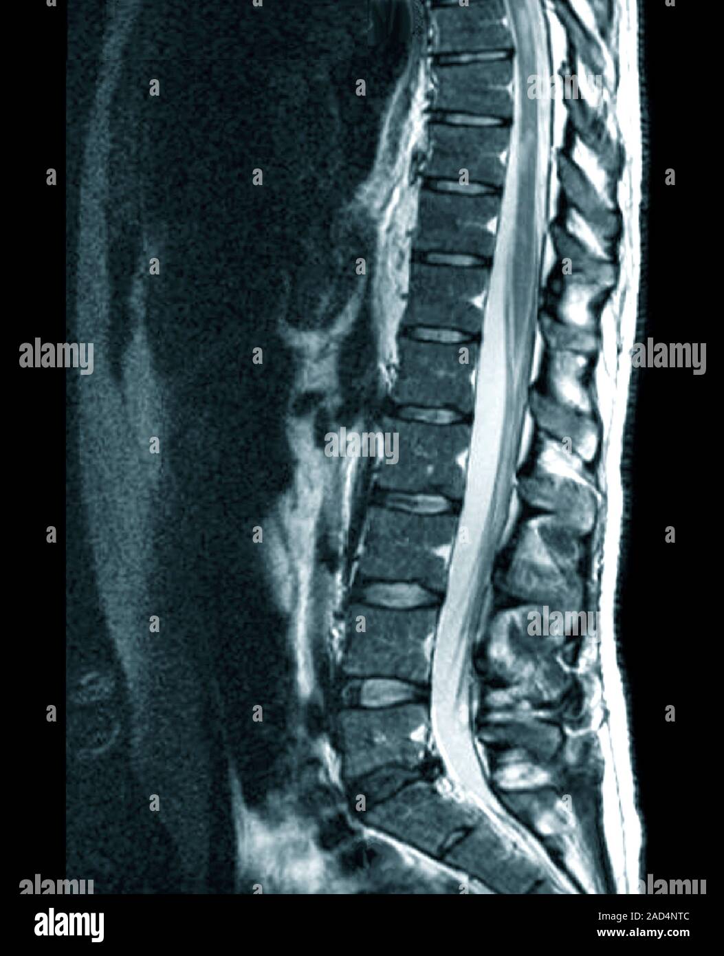 Columna Vertebral En La Esclerosis M Ltiple Im Genes Por Resonancia