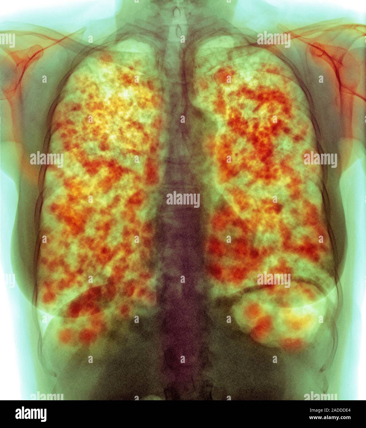 C Ncer Pulmonar Secundaria Color De Rayos X De T Rax De Una Secci N A