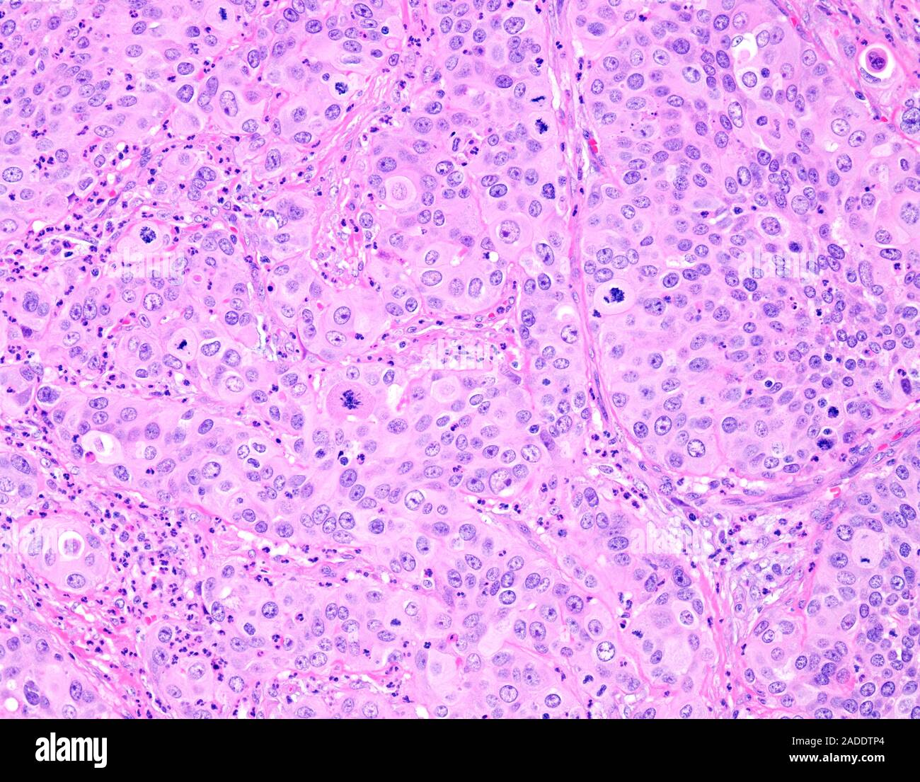 Micrografía de luz de carcinoma urotelial de alto grado también