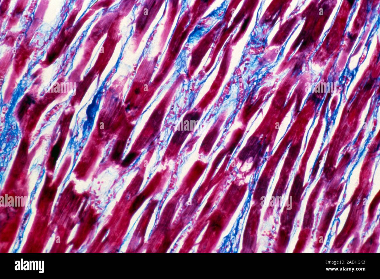 La Miocarditis Micrograf A De Luz Del M Sculo Cardiaco Humano Con