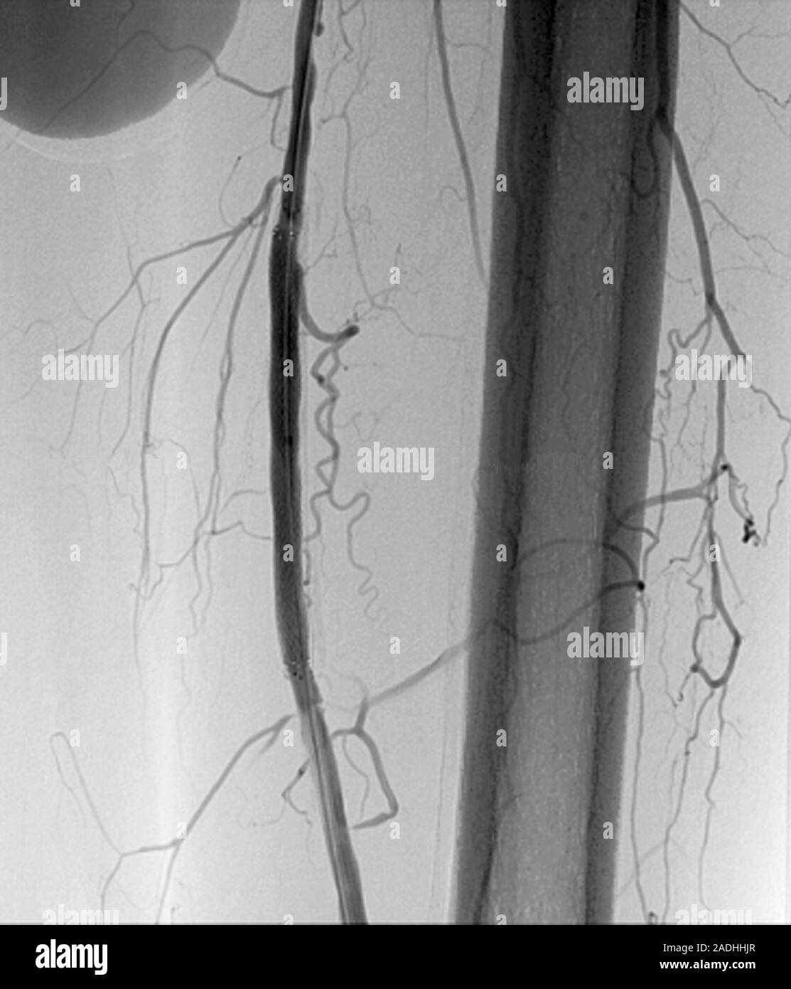 Un Stent En La Arteria Femoral Angiograf A De Un Stent En La Arteria