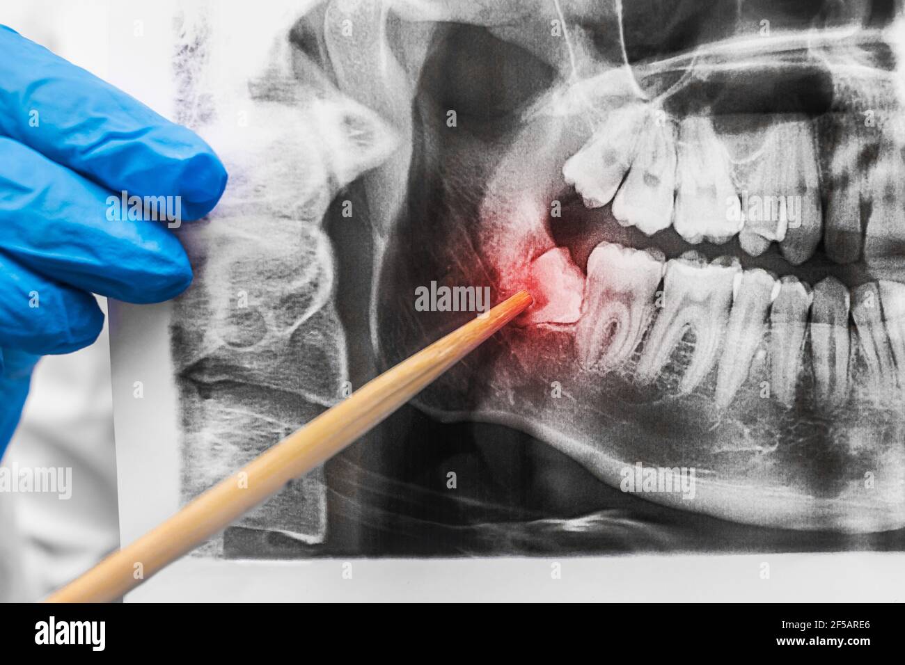 La mano del dentista en un guante de goma médica sostiene una imagen de