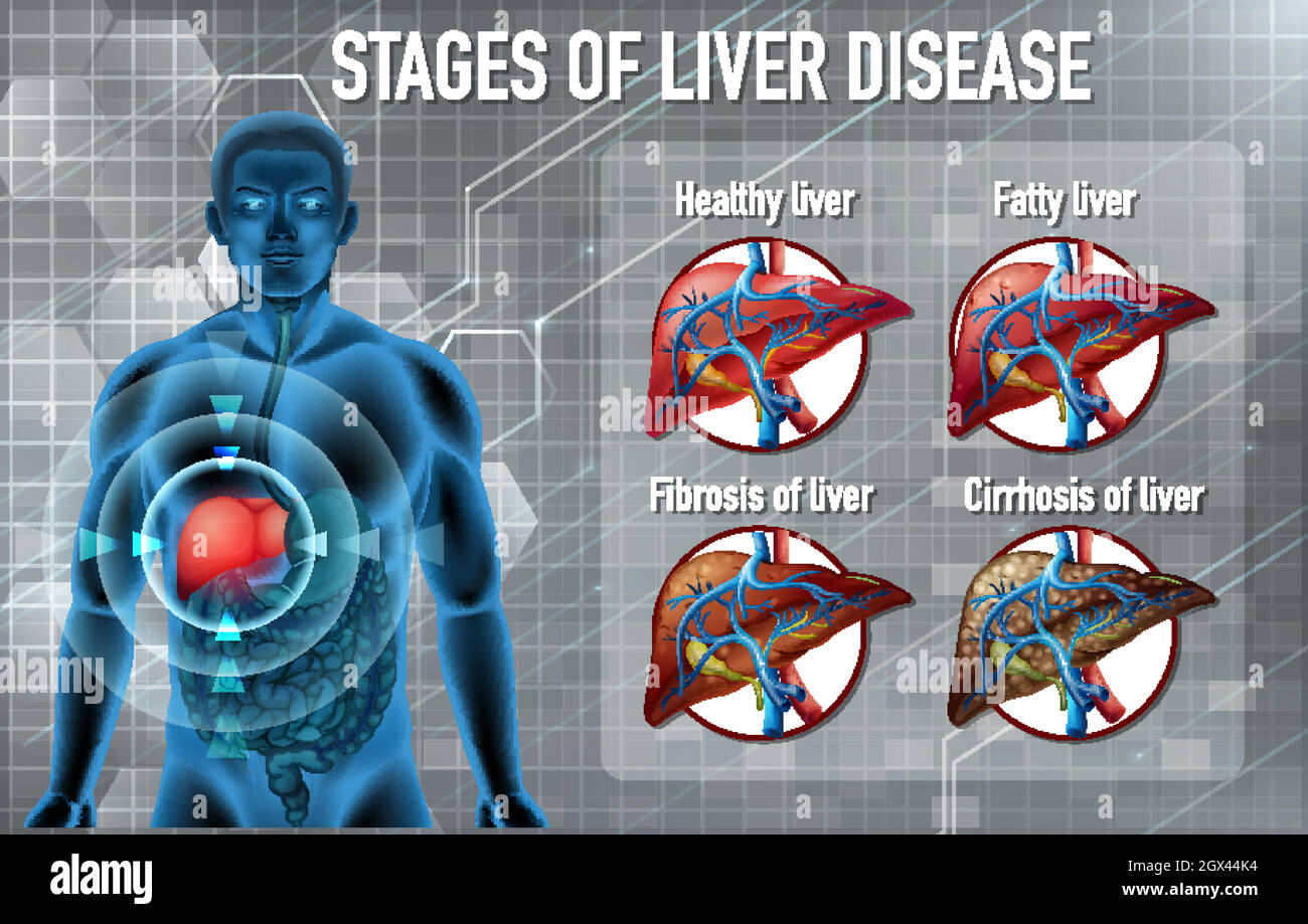 Etapas de la enfermedad hepãtica fotografías e imágenes de alta