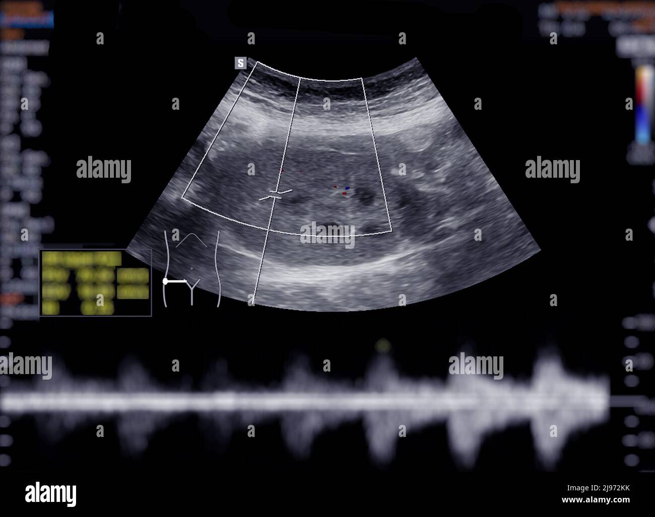 Ecograf A Del Abdomen Superior Que Muestra El Ri N Fotograf A De Stock