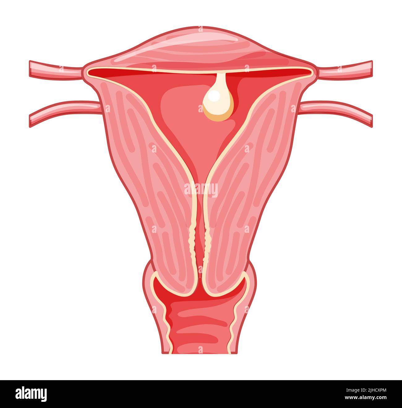 P Lipos Pedunculados En El Tero Sistema Reproductor Femenino En