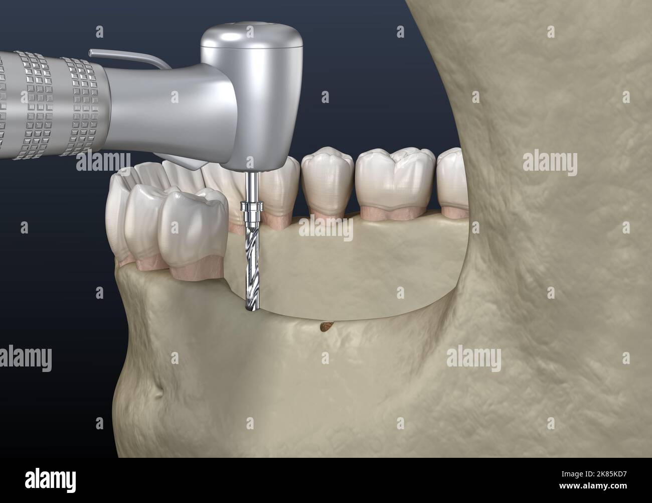 Hendidura De La Cresta Alveolar Aumento Cirug A Dental Ilustraci N