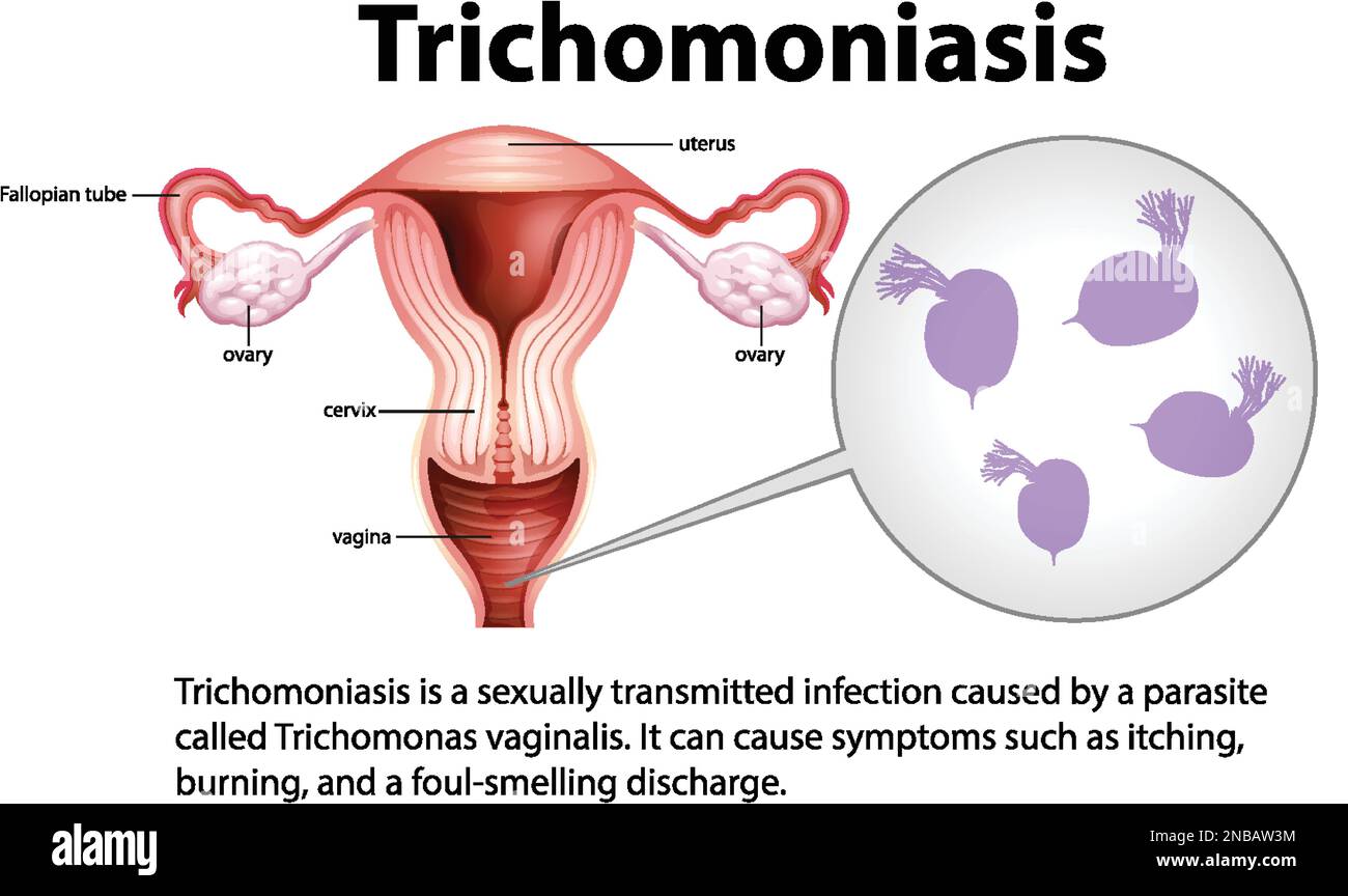 Infografía de tricomoniasis con ilustración explicativa Imagen Vector