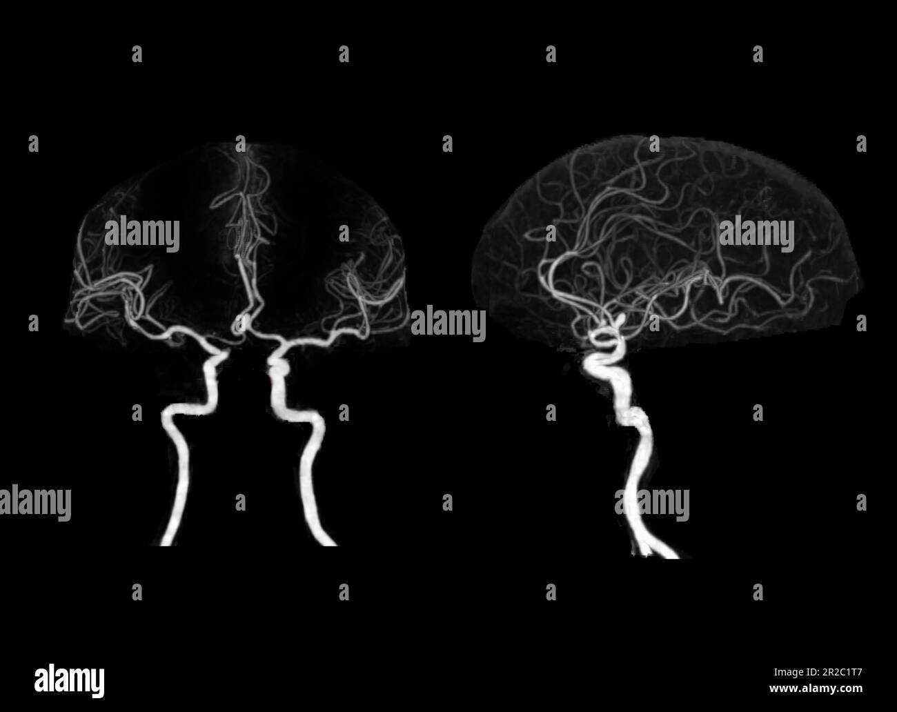 Angiografía por TC del cerebro o CTA cerebral que muestra la arteria