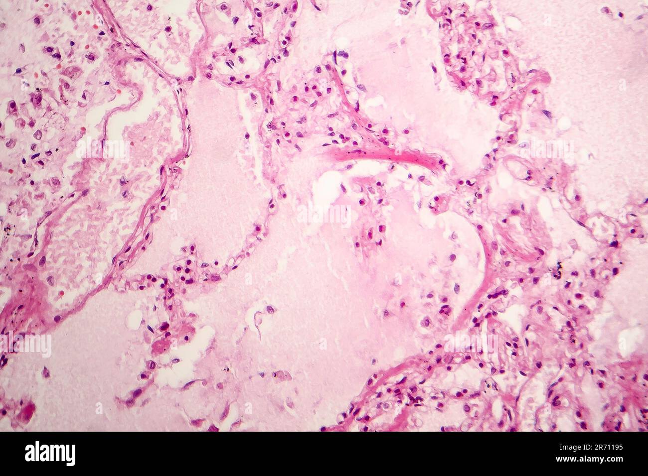 Histopatología del edema pulmonar agudo micrografía de luz que muestra