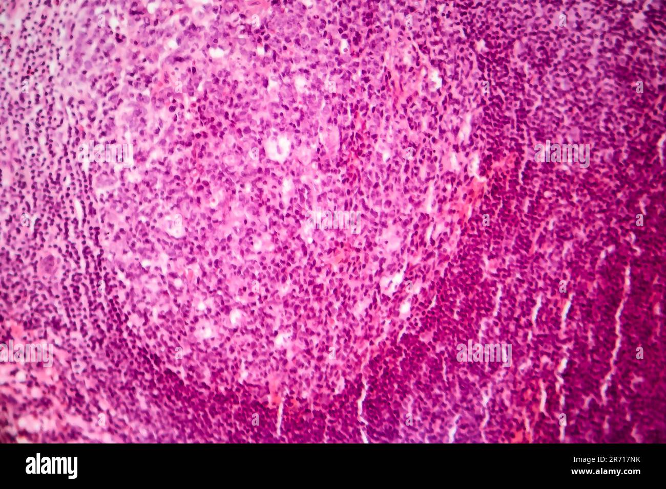 Apendicitis Simple Aguda Micrograf A De Luz Foto Bajo Microscopio