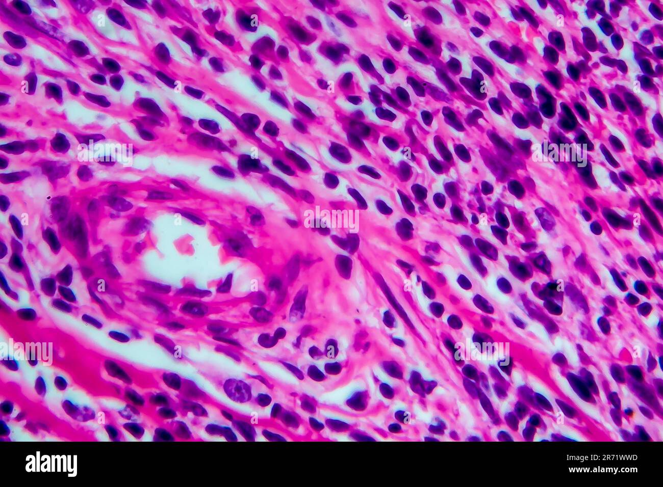 Linfoma De Hodgkin Micrograf A De Luz Foto Al Microscopio Gran