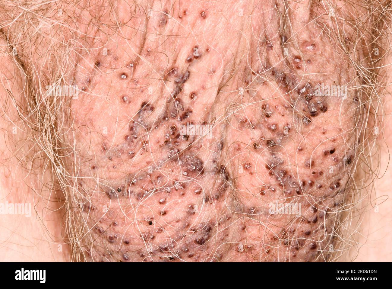 Angioqueratoma De Fordyce Fotograf A De Stock Alamy