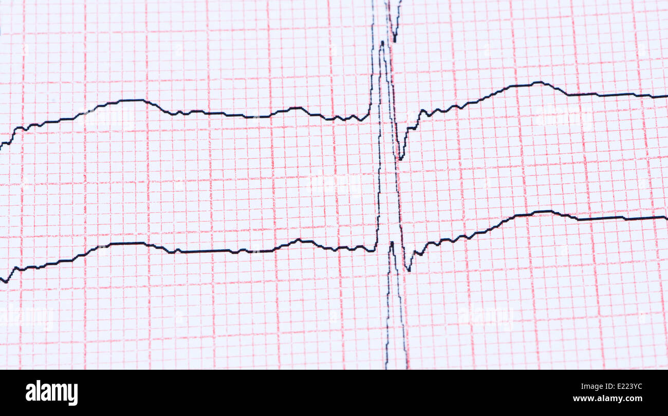 Electrocardiograma Realizado En Papel Fotograf A De Stock Alamy