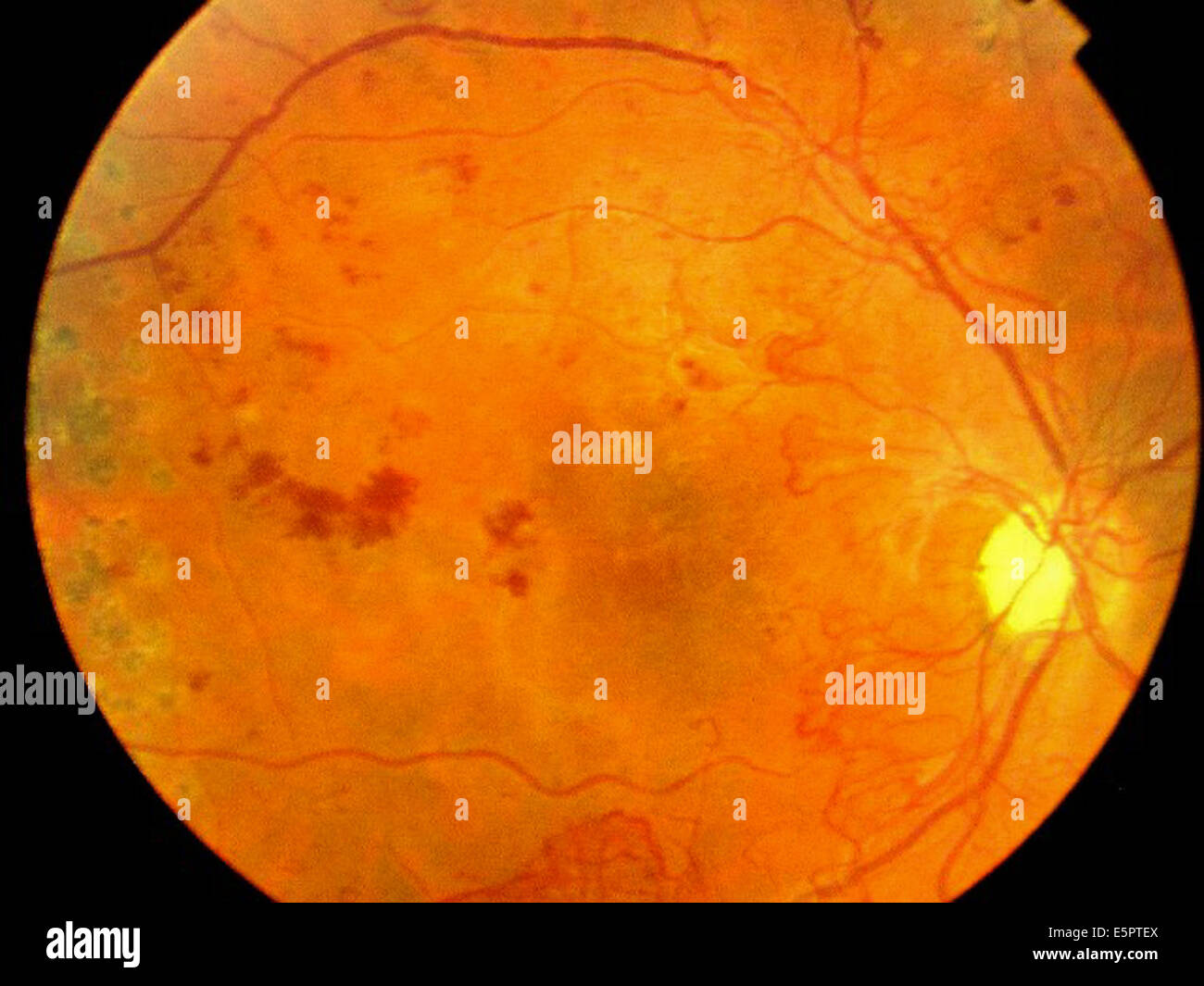 Imagen de la cámara de fondo de ojo oftalmoscopio de la retina