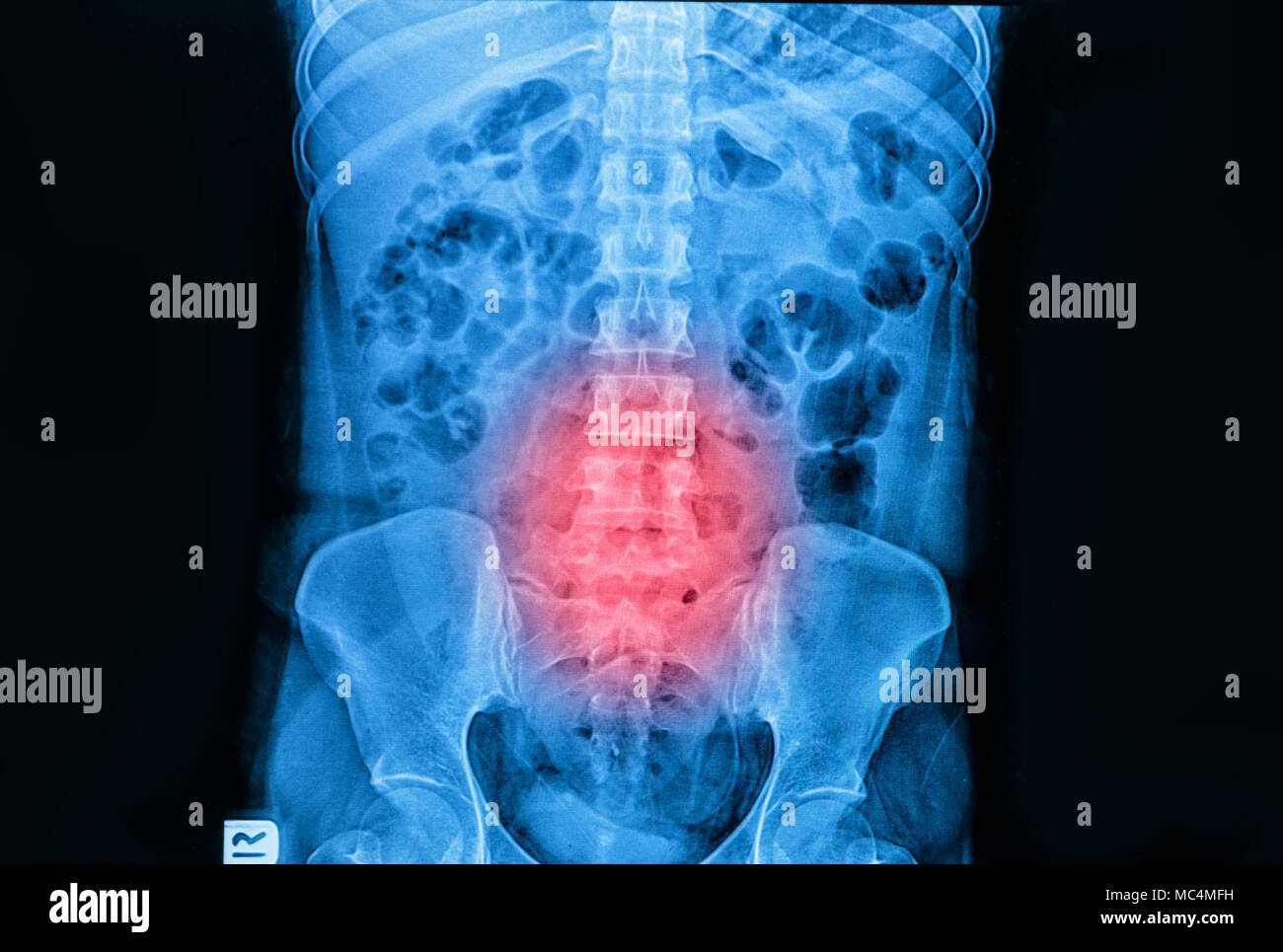 La Imagen De Rayos X De La Columna Vertebral Y La Pelvis De Una Parte