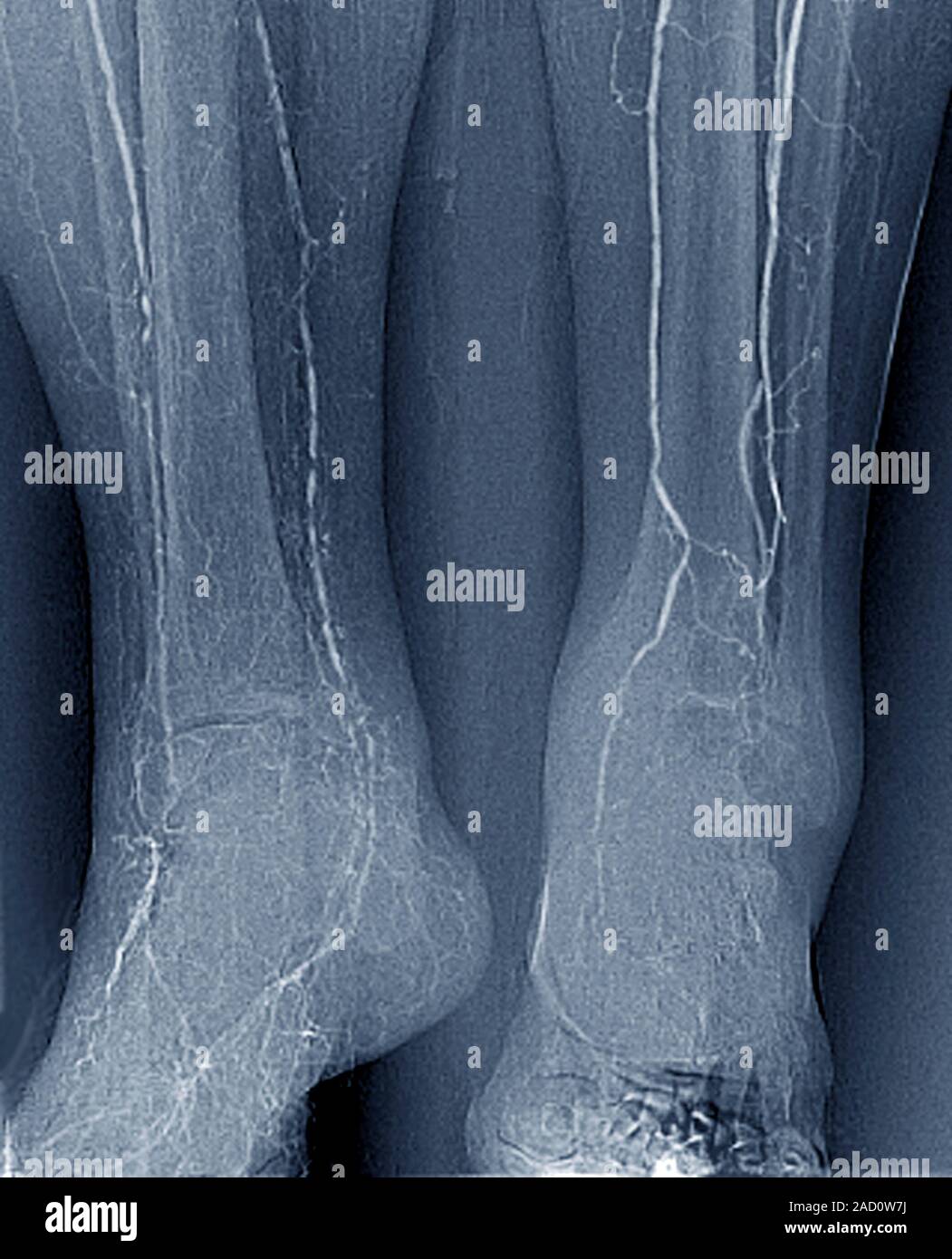 Dans Le Diab Te Art Rite X Ray Angiogramme D Une Section Travers La