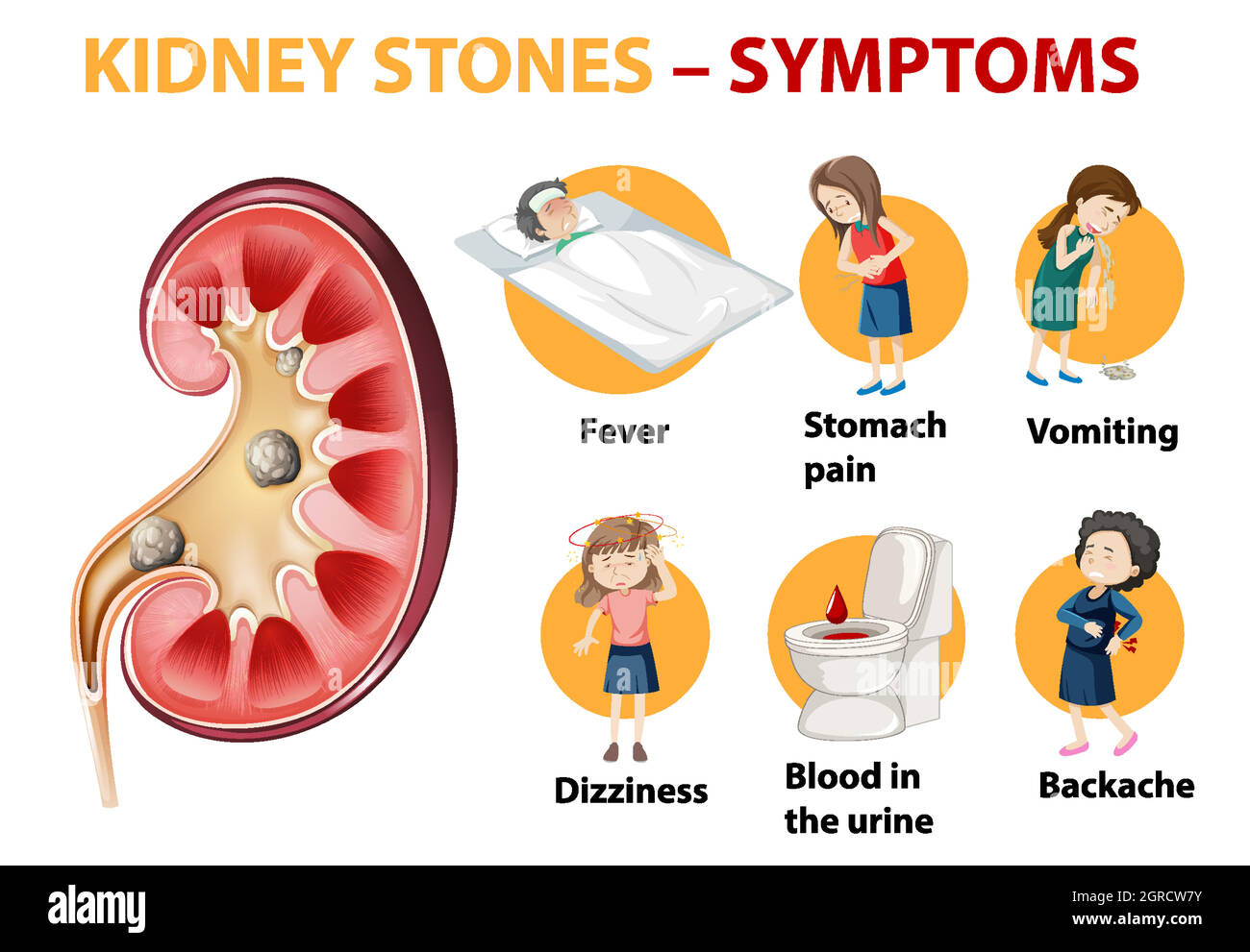 Infographie sur les symptômes des calculs rénaux Image Vectorielle