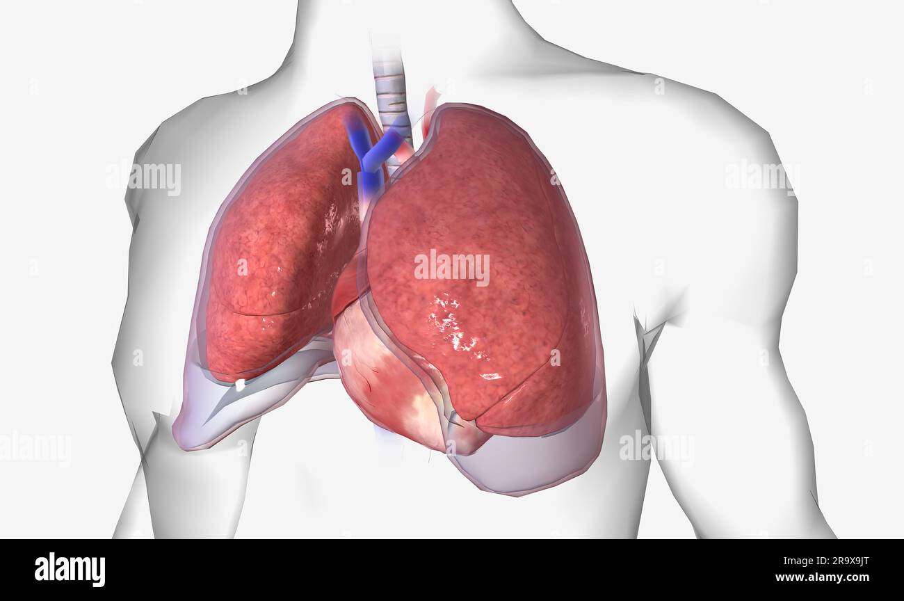 L épanchement pleural est une affection pulmonaire caractérisée par une