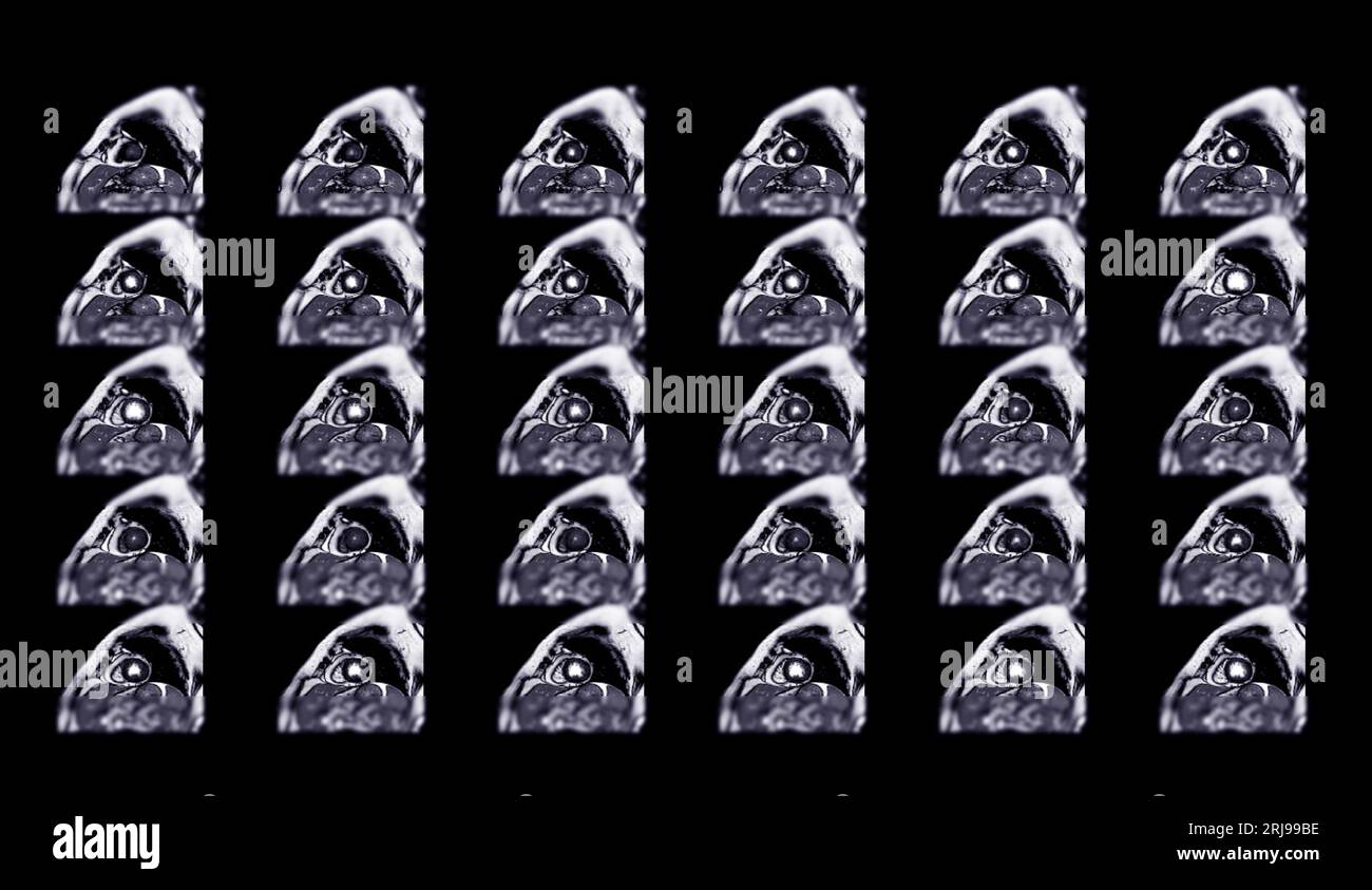 IRM cardiaque ou IRM cardiaque imagerie par résonance magnétique du