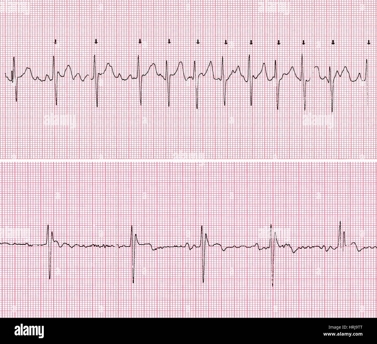 Ecg Ekg Pathology Banque De Photographies Et Dimages Haute