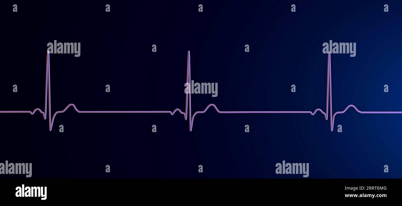 Bradicardia Ecg Immagini E Fotografie Stock Ad Alta Risoluzione Alamy