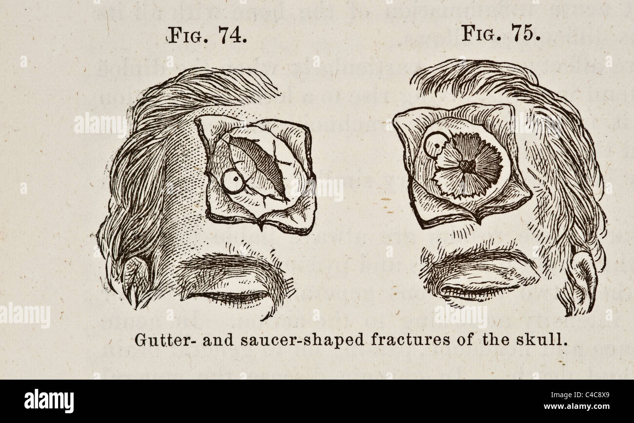 Frattura Alla Base Del Cranio Immagini E Fotografie Stock Ad Alta