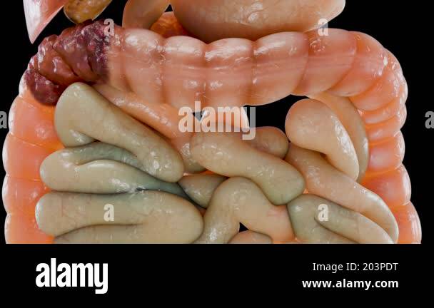 Colorectal cancer, malignant tumor in intestine, Endoscope inside ...