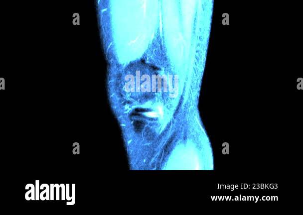 MRI knee joint. Magnetic resonance imaging of right knee. Diagnosis ...