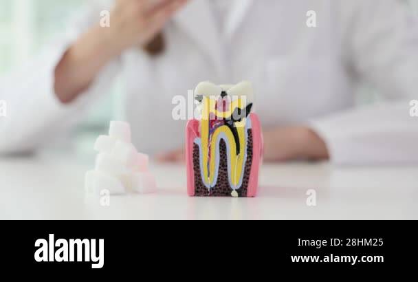 Model of tooth with cavities and sugar cubes placed on table. Dentist ...