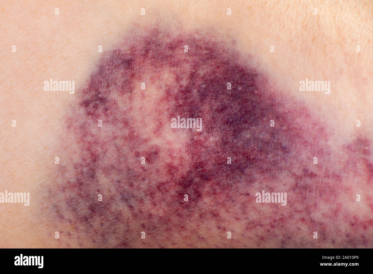 Close up of a hematoma on the arm of woman. Stock Photo