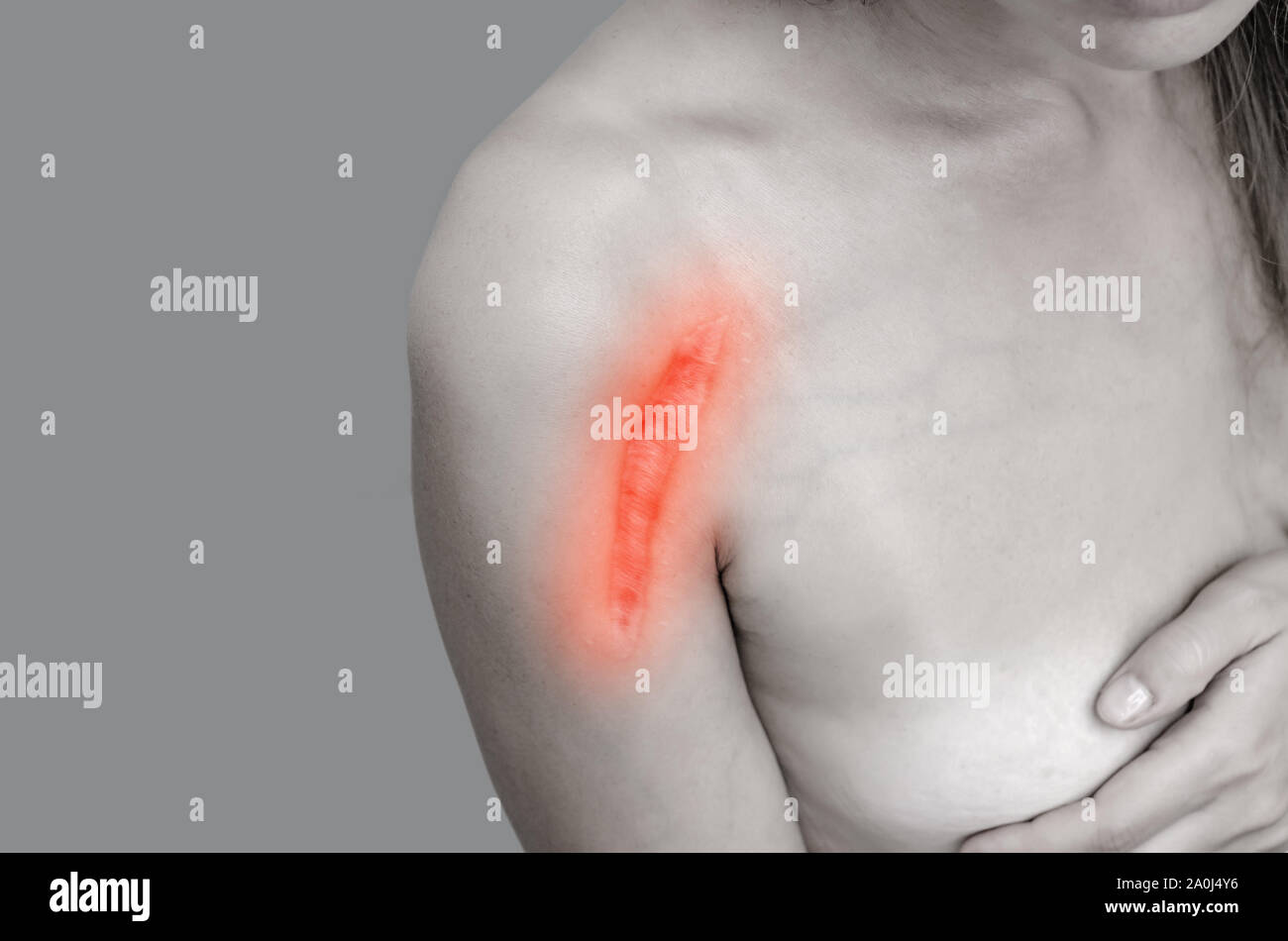 Close up of female shoulder with a scar after install a metal plate