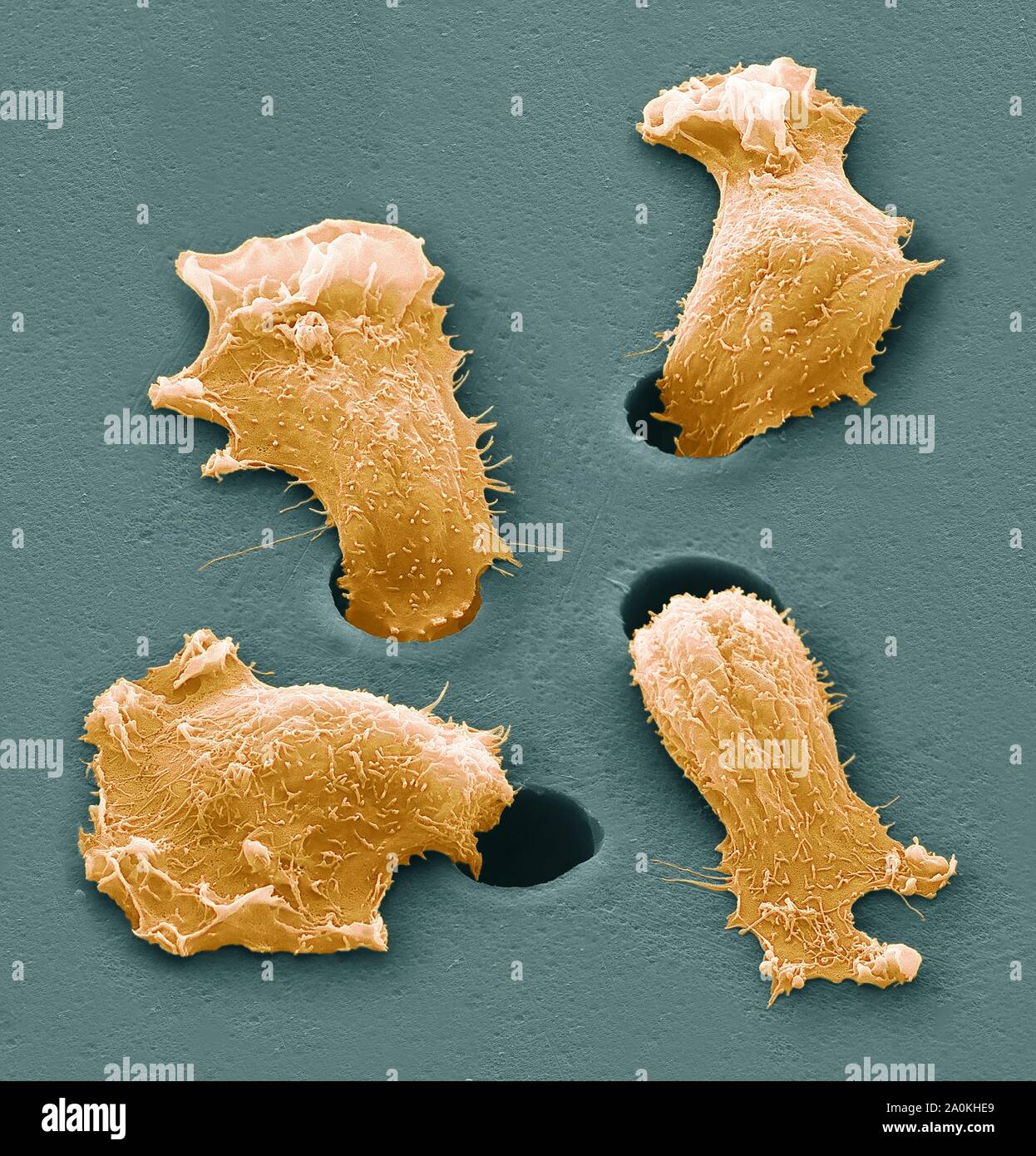 Tumour cells micrograph hi-res stock photography and images - Alamy