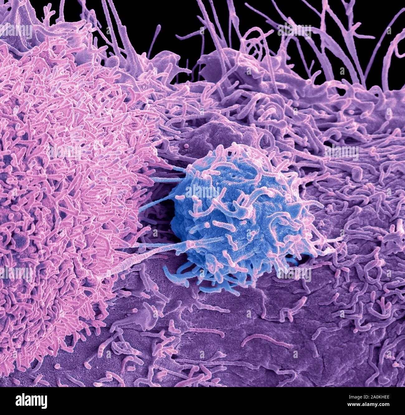 Prostate cancer cells, SEM Stock Photo