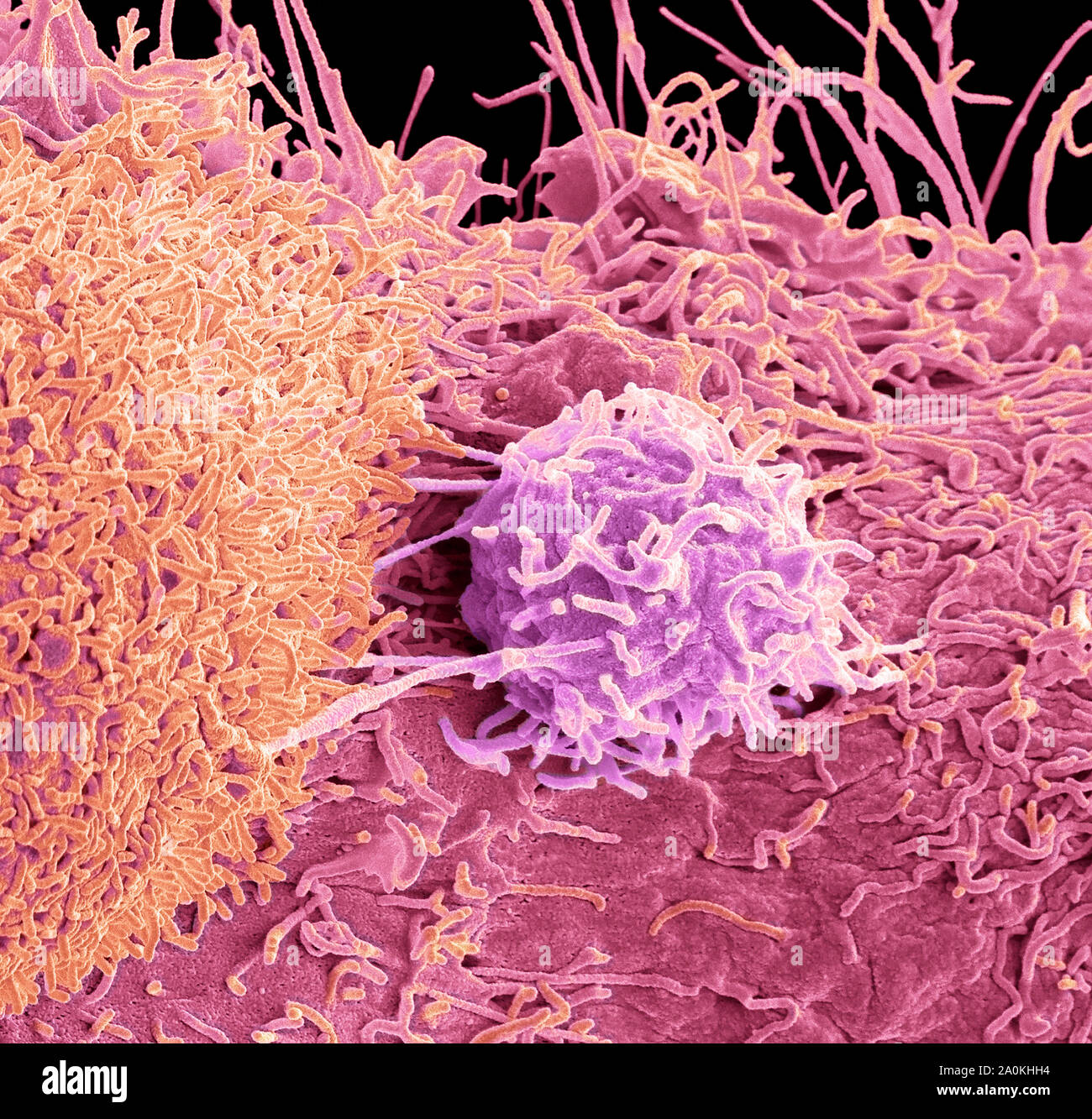 Prostate cancer cells, SEM Stock Photo