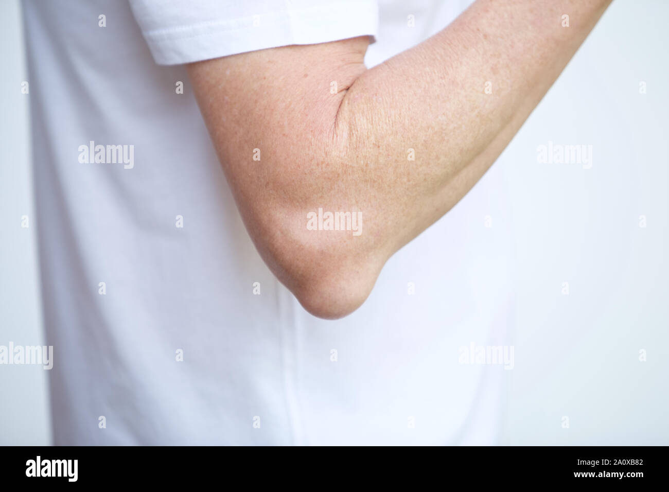 Swelling associated with Bursitis of the elbow Stock Photo Alamy